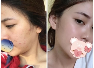  feedback trị mụn sau khi sử dụng sản phẩm Dr.Mai tại hệ thống https://drmaichinhhang.vn/