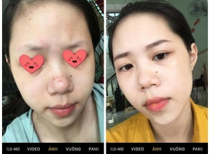  feedback trị mụn sau khi sử dụng sản phẩm Dr.Mai tại hệ thống https://drmaichinhhang.vn/