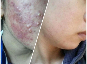  feedback trị mụn sau khi sử dụng sản phẩm Dr.Mai tại hệ thống https://drmaichinhhang.vn/