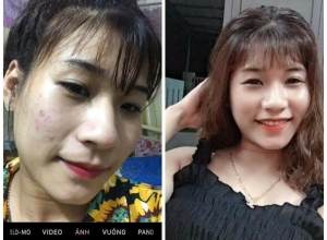  feedback trị mụn sau khi sử dụng sản phẩm Dr.Mai tại hệ thống https://drmaichinhhang.vn/