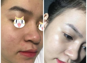  feedback trị mụn sau khi sử dụng sản phẩm Dr.Mai tại hệ thống https://drmaichinhhang.vn/