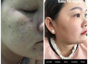  feedback trị mụn sau khi sử dụng sản phẩm Dr.Mai tại hệ thống https://drmaichinhhang.vn/