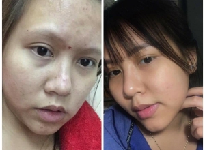  feedback trị mụn sau khi sử dụng sản phẩm Dr.Mai tại hệ thống https://drmaichinhhang.vn/