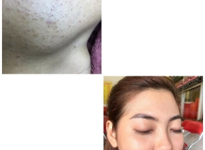  feedback trị mụn sau khi sử dụng sản phẩm Dr.Mai tại hệ thống https://drmaichinhhang.vn/