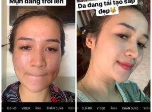  feedback trị mụn sau khi sử dụng sản phẩm Dr.Mai tại hệ thống https://drmaichinhhang.vn/