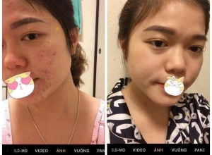  feedback trị mụn sau khi sử dụng sản phẩm Dr.Mai tại hệ thống https://drmaichinhhang.vn/