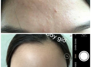  feedback trị mụn sau khi sử dụng sản phẩm Dr.Mai tại hệ thống https://drmaichinhhang.vn/