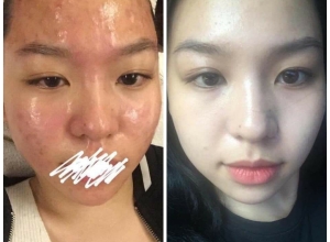  feedback trị mụn sau khi sử dụng sản phẩm Dr.Mai tại hệ thống https://drmaichinhhang.vn/