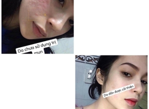  feedback trị mụn sau khi sử dụng sản phẩm Dr.Mai tại hệ thống https://drmaichinhhang.vn/