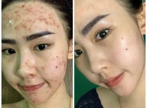  feedback trị mụn sau khi sử dụng sản phẩm Dr.Mai tại hệ thống https://drmaichinhhang.vn/