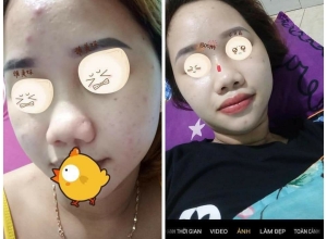  feedback trị mụn sau khi sử dụng sản phẩm Dr.Mai tại hệ thống https://drmaichinhhang.vn/