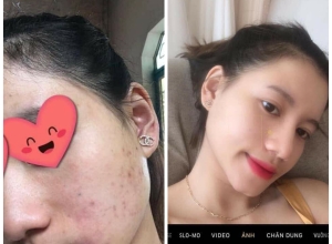  feedback trị mụn sau khi sử dụng sản phẩm Dr.Mai tại hệ thống https://drmaichinhhang.vn/