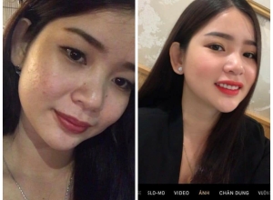  feedback trị mụn sau khi sử dụng sản phẩm Dr.Mai tại hệ thống https://drmaichinhhang.vn/