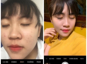  feedback trị mụn sau khi sử dụng sản phẩm Dr.Mai tại hệ thống https://drmaichinhhang.vn/