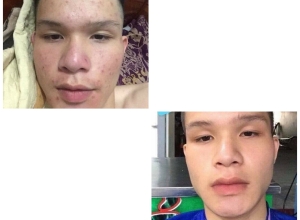  feedback trị mụn sau khi sử dụng sản phẩm Dr.Mai tại hệ thống https://drmaichinhhang.vn/