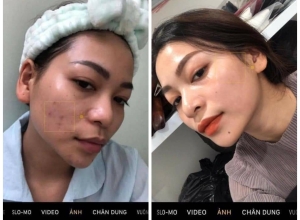  feedback trị mụn sau khi sử dụng sản phẩm Dr.Mai tại hệ thống https://drmaichinhhang.vn/