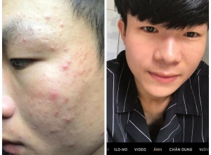  feedback trị mụn sau khi sử dụng sản phẩm Dr.Mai tại hệ thống https://drmaichinhhang.vn/