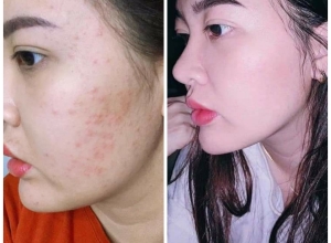  feedback trị mụn sau khi sử dụng sản phẩm Dr.Mai tại hệ thống https://drmaichinhhang.vn/