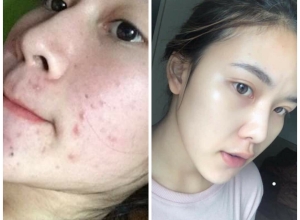  feedback trị mụn sau khi sử dụng sản phẩm Dr.Mai tại hệ thống https://drmaichinhhang.vn/