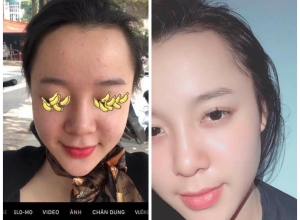  feedback trị mụn sau khi sử dụng sản phẩm Dr.Mai tại hệ thống https://drmaichinhhang.vn/