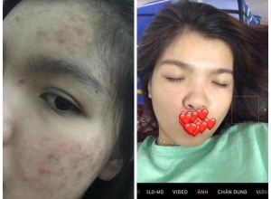  feedback trị mụn sau khi sử dụng sản phẩm Dr.Mai tại hệ thống https://drmaichinhhang.vn/