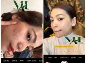  feedback trị mụn sau khi sử dụng sản phẩm Dr.Mai tại hệ thống https://drmaichinhhang.vn/