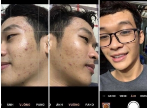  feedback trị mụn sau khi sử dụng sản phẩm Dr.Mai tại hệ thống https://drmaichinhhang.vn/