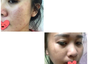  feedback trị mụn sau khi sử dụng sản phẩm Dr.Mai tại hệ thống https://drmaichinhhang.vn/