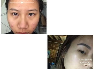  feedback trị mụn sau khi sử dụng sản phẩm Dr.Mai tại hệ thống https://drmaichinhhang.vn/