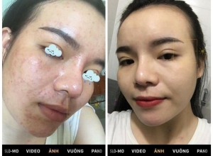  feedback trị mụn sau khi sử dụng sản phẩm Dr.Mai tại hệ thống https://drmaichinhhang.vn/