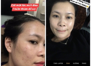  feedback trị mụn sau khi sử dụng sản phẩm Dr.Mai tại hệ thống https://drmaichinhhang.vn/