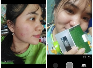  feedback trị mụn sau khi sử dụng sản phẩm Dr.Mai tại hệ thống https://drmaichinhhang.vn/