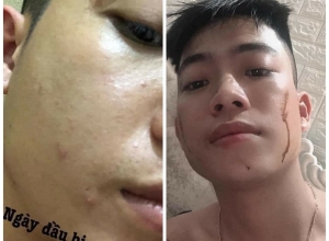  feedback trị mụn sau khi sử dụng sản phẩm Dr.Mai tại hệ thống https://drmaichinhhang.vn/