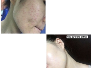  feedback trị mụn sau khi sử dụng sản phẩm Dr.Mai tại hệ thống https://drmaichinhhang.vn/