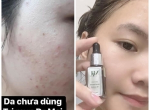  feedback trị mụn sau khi sử dụng sản phẩm Dr.Mai tại hệ thống https://drmaichinhhang.vn/