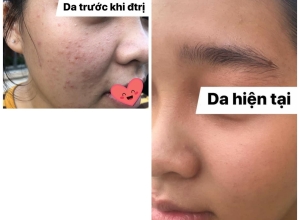  feedback trị mụn sau khi sử dụng sản phẩm Dr.Mai tại hệ thống https://drmaichinhhang.vn/