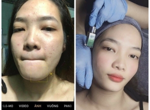  feedback trị mụn sau khi sử dụng sản phẩm Dr.Mai tại hệ thống https://drmaichinhhang.vn/