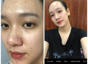  feedback trị mụn sau khi sử dụng sản phẩm Dr.Mai tại hệ thống https://drmaichinhhang.vn/