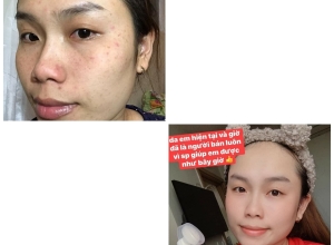  feedback trị mụn sau khi sử dụng sản phẩm Dr.Mai tại hệ thống https://drmaichinhhang.vn/