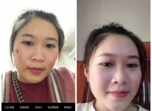  feedback trị mụn sau khi sử dụng sản phẩm Dr.Mai tại hệ thống https://drmaichinhhang.vn/