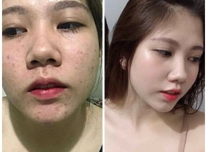  feedback trị mụn sau khi sử dụng sản phẩm Dr.Mai tại hệ thống https://drmaichinhhang.vn/