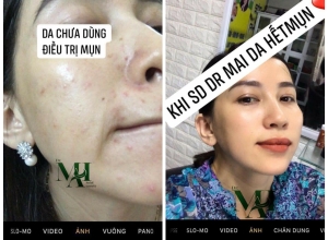  feedback trị mụn sau khi sử dụng sản phẩm Dr.Mai tại hệ thống https://drmaichinhhang.vn/