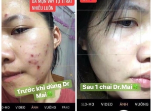  feedback trị mụn sau khi sử dụng sản phẩm Dr.Mai tại hệ thống https://drmaichinhhang.vn/