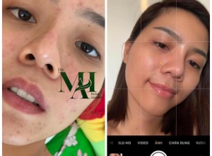  feedback trị mụn sau khi sử dụng sản phẩm Dr.Mai tại hệ thống https://drmaichinhhang.vn/