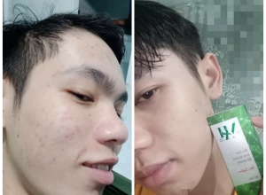  feedback trị mụn sau khi sử dụng sản phẩm Dr.Mai tại hệ thống https://drmaichinhhang.vn/