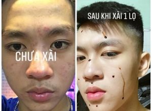  feedback trị mụn sau khi sử dụng sản phẩm Dr.Mai tại hệ thống https://drmaichinhhang.vn/