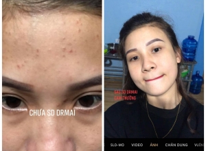  feedback trị mụn sau khi sử dụng sản phẩm Dr.Mai tại hệ thống https://drmaichinhhang.vn/