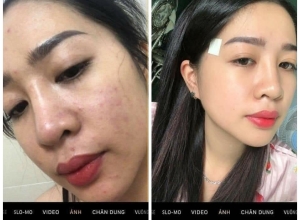  feedback trị mụn sau khi sử dụng sản phẩm Dr.Mai tại hệ thống https://drmaichinhhang.vn/