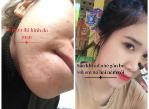  feedback trị mụn sau khi sử dụng sản phẩm Dr.Mai tại hệ thống https://drmaichinhhang.vn/