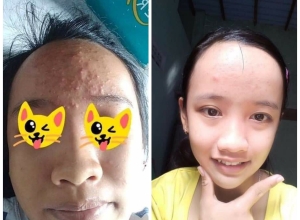  feedback trị mụn sau khi sử dụng sản phẩm Dr.Mai tại hệ thống https://drmaichinhhang.vn/